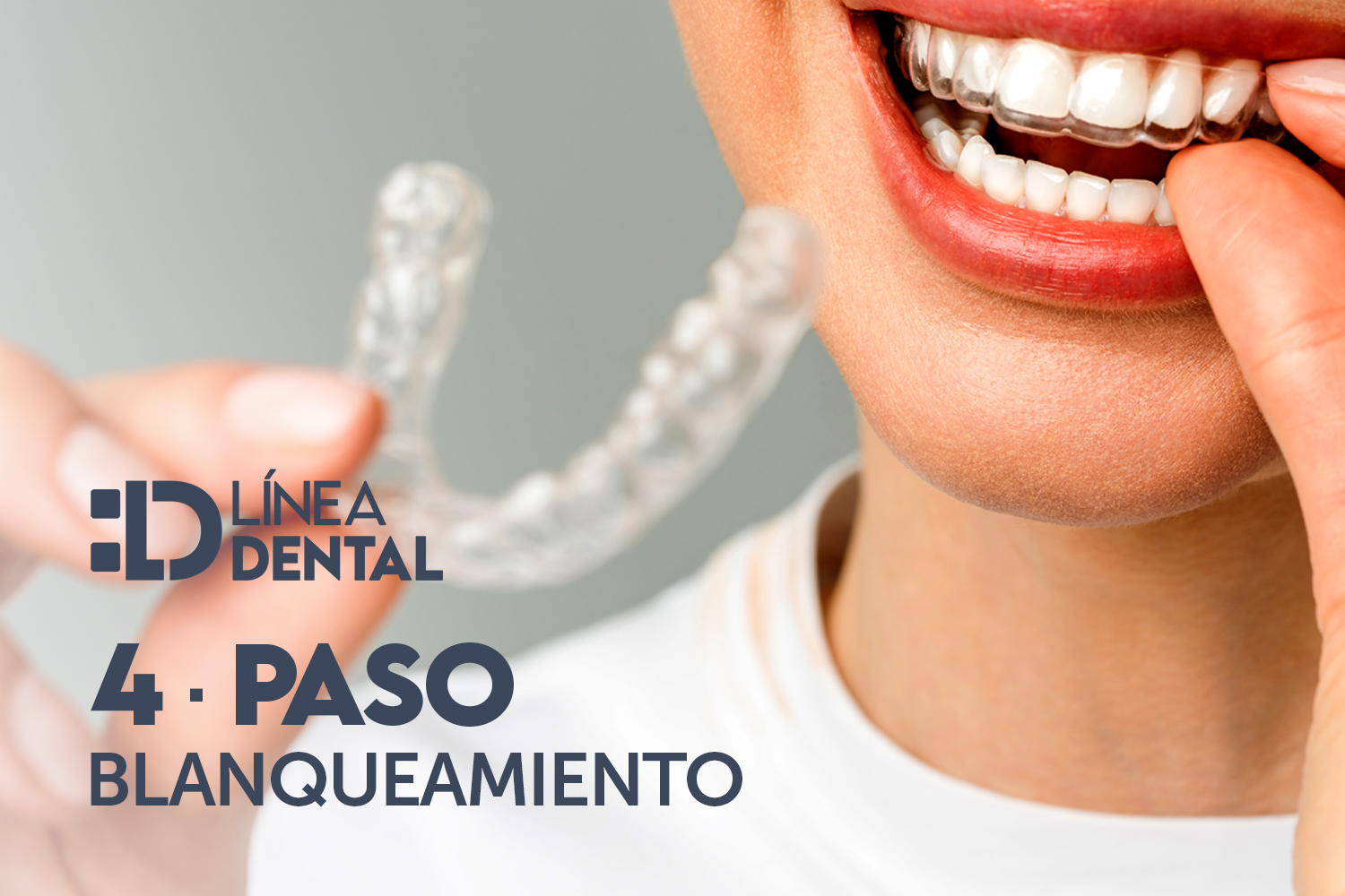 Blanqueamiento dental en Línea Dental Ciudad Real y Miguelturra