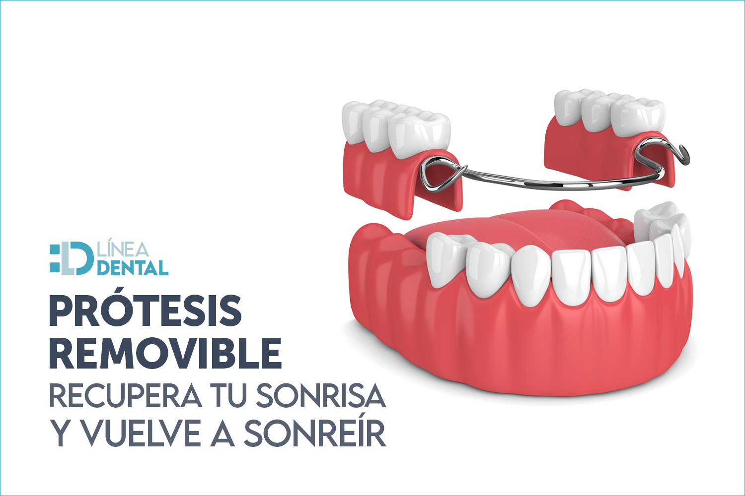 01-protesis-dentales-removible-recupera-tu-sonrisa-vuelva-sonreir-linea-dental-ciudad-real-miguelturra