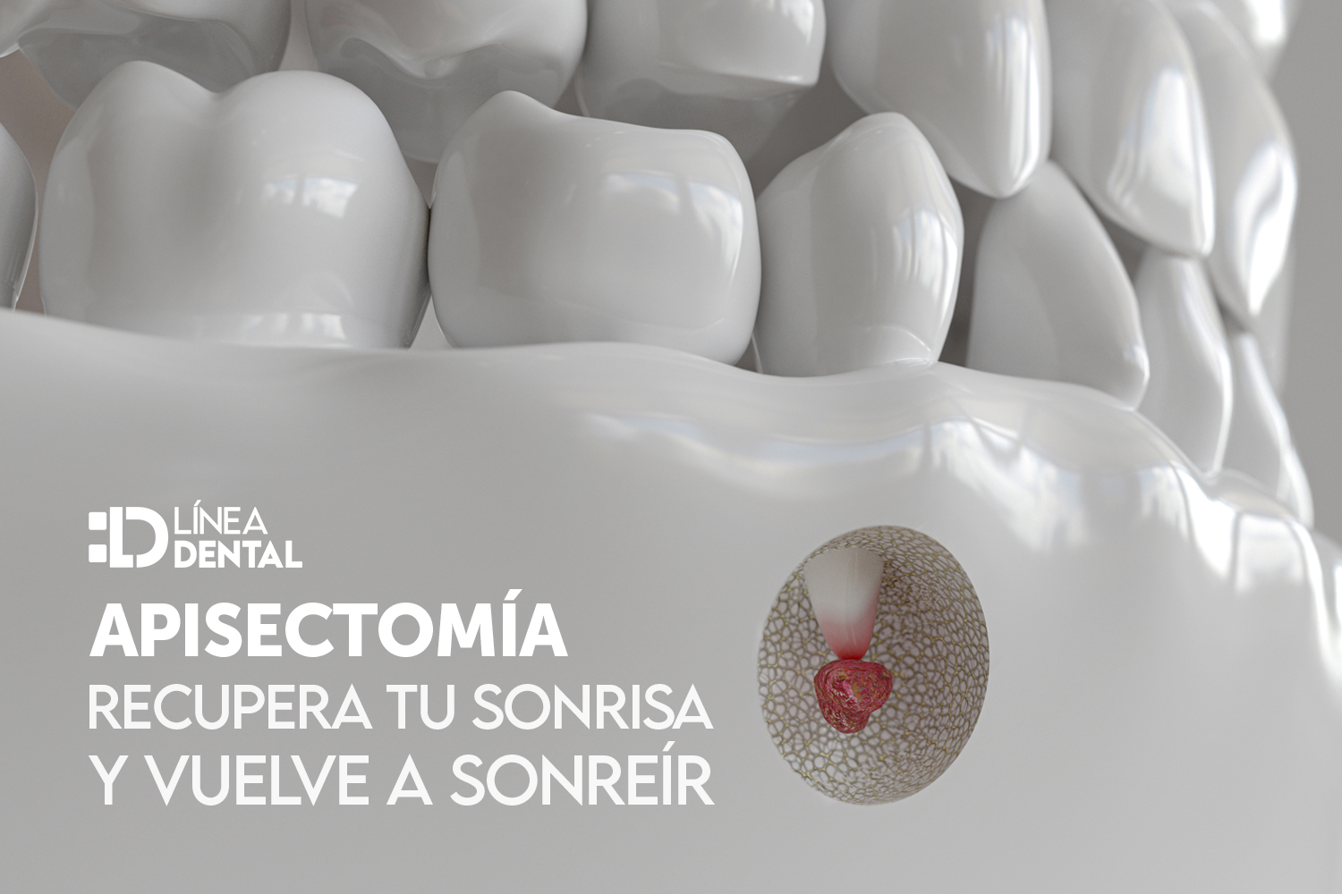 apisectomia-dentista-odontologo-linea-dental-ciudad-real-miguelturra