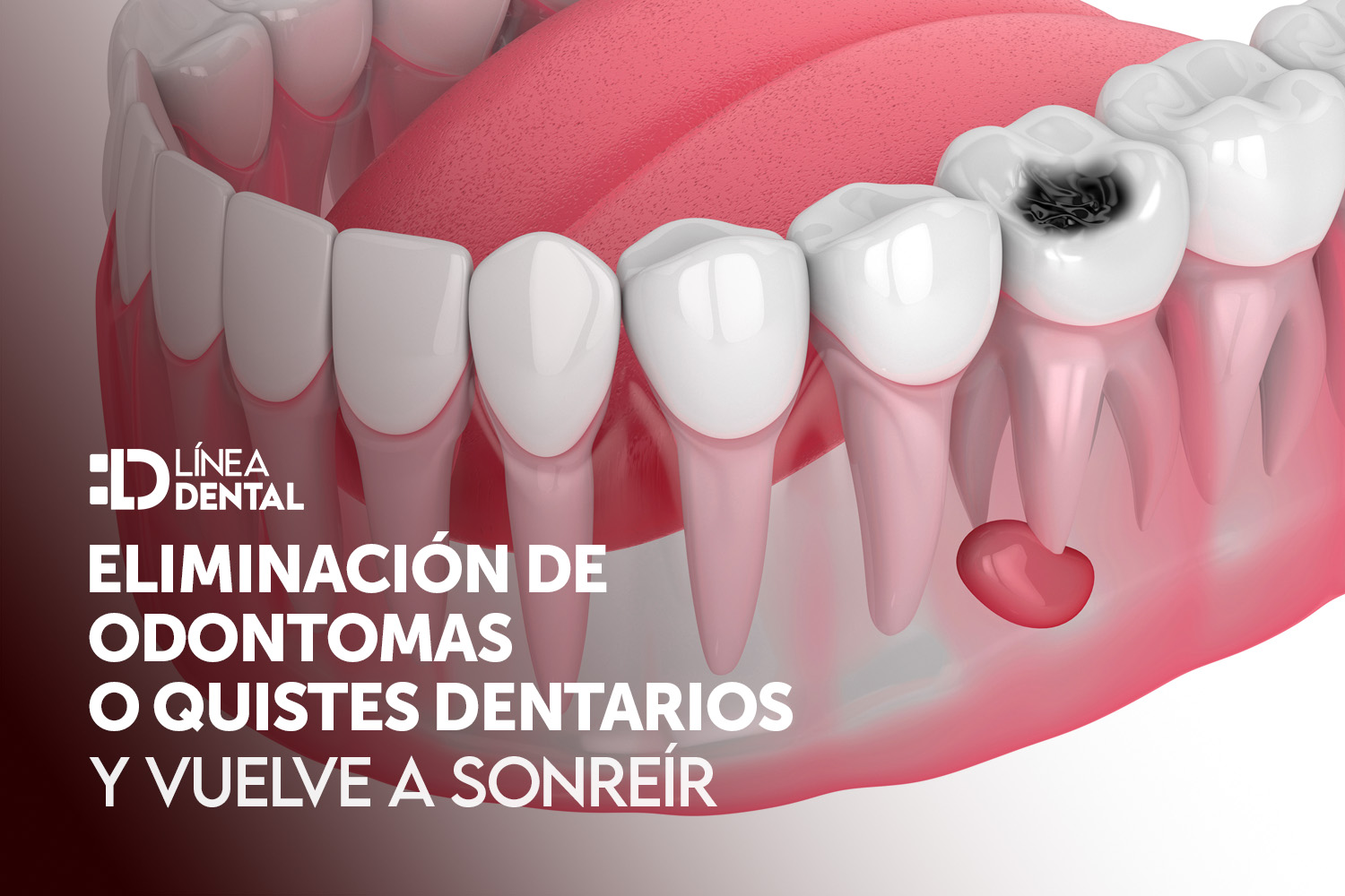 eliminacion-odontoma-quistes-dentarios-dentista-odontologo-linea-dental-ciudad-real-miguelturra
