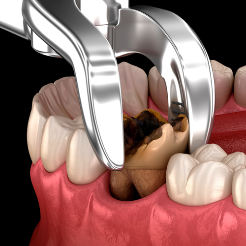 exodoncia-dentista-odontologo-linea-dental-ciudad-real-miguelturra-cirugia-oral-01