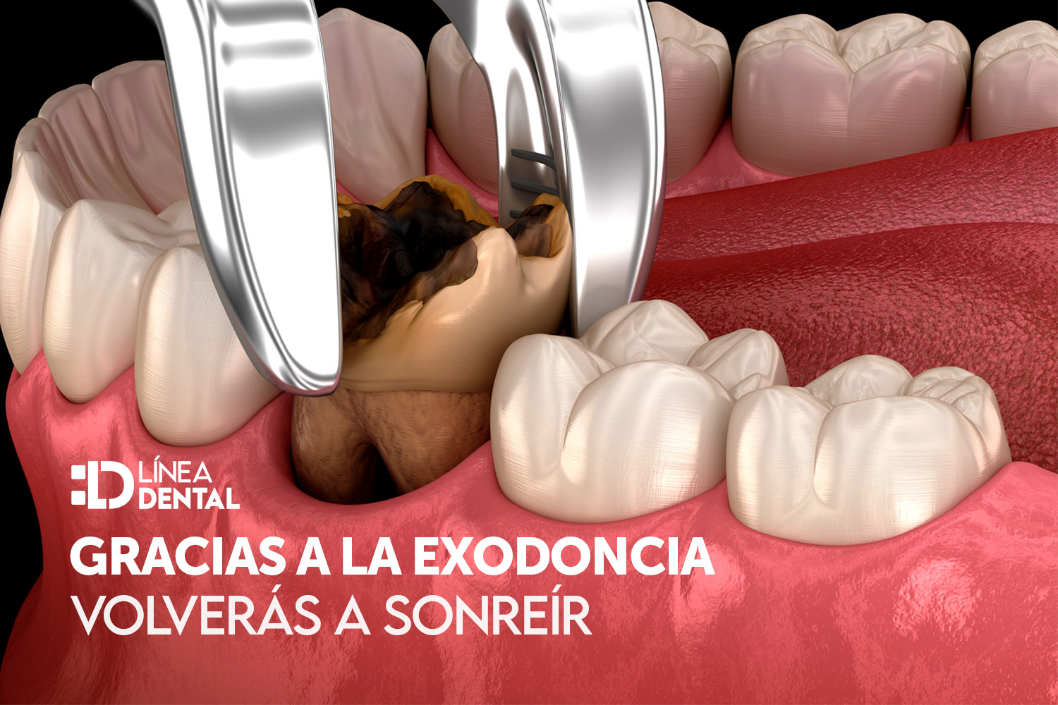 exodoncia-dentista-odontologo-linea-dental-ciudad-real-miguelturra