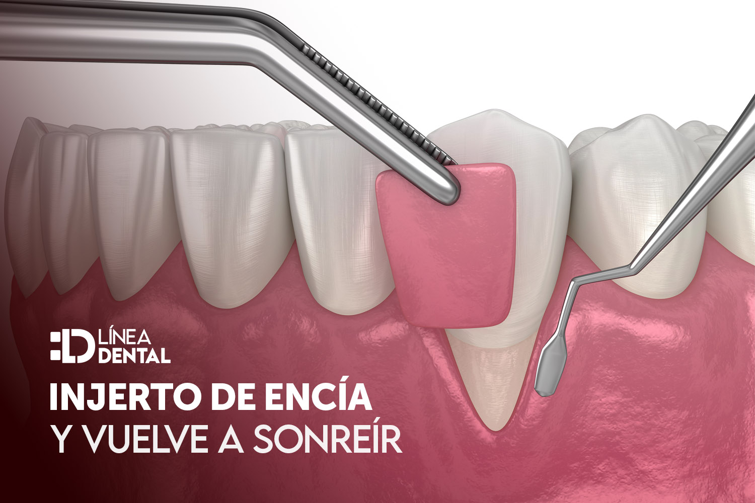 injerto-de-encia-dentista-odontologo-linea-dental-ciudad-real-miguelturra