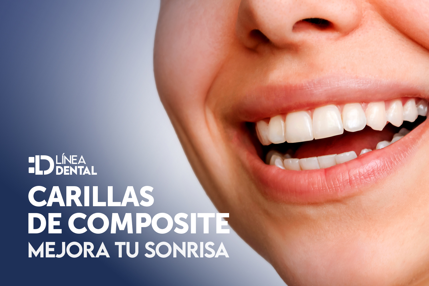 mejora-tu-sonrisa-carillas-composite-linea-dental-ciudad-real-miguelturra