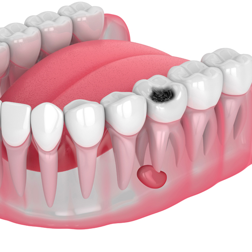 odontoma-quistes-dentarios-linea-dental-ciudad-real-miguelturra-cirugia-oral-01