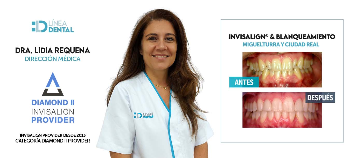 06-clinicas-dentales-linea-dental-invisalign-ciudad-real-miguelturra