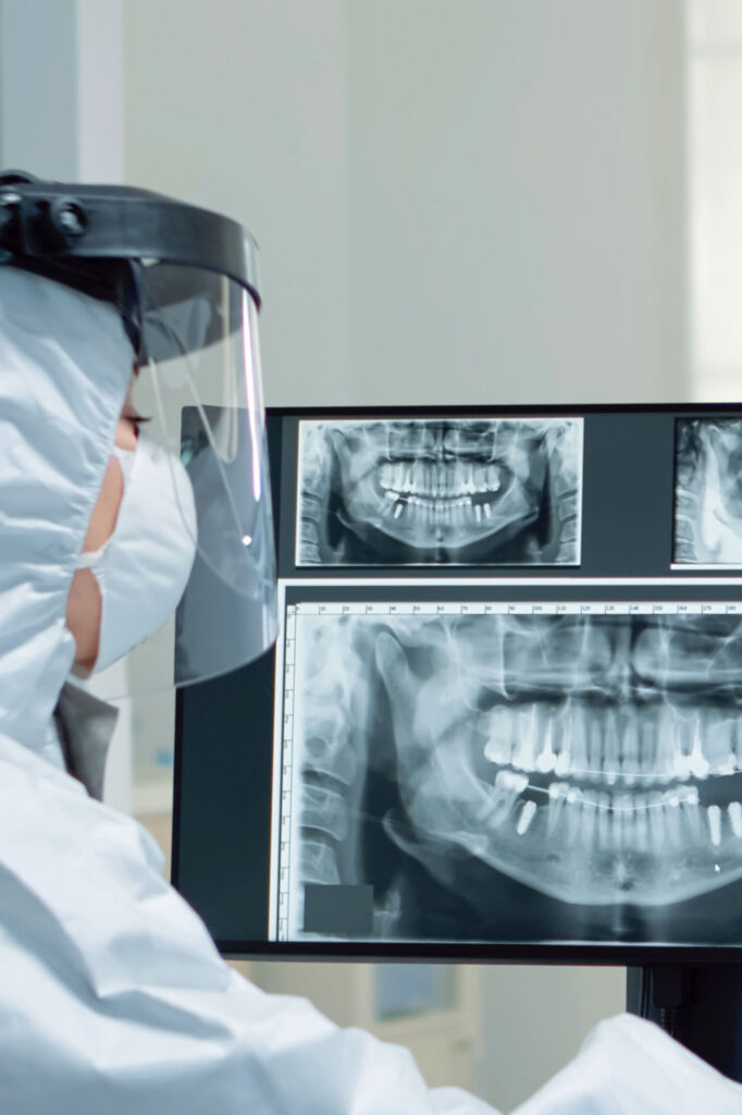Los injertos de hueso son una avanzada técnica en odontología que permite restaurar la pérdida ósea en el maxilar o mandíbula, creando una base sólida para la colocación exitosa de implantes dentales. Línea Dental Ciudad Real y Miguelturra