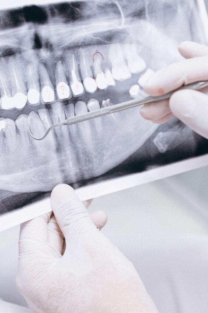 Los implantes dentales son la solución más avanzada y duradera para reemplazar dientes perdidos. Si has perdido uno o varios dientes debido a una lesión, enfermedad periodontal o cualquier otra razón, los implantes dentales pueden ayudarte a recuperar la funcionalidad de tu dentición y la confianza en tu sonrisa. Línea Dental Ciudad Real y Miguelturra