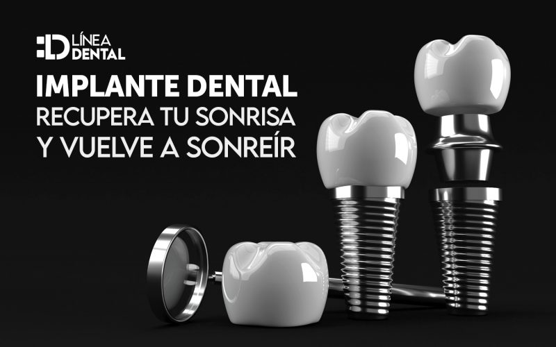03-implantes-dentales-recupera-tu-sonrisa-vuelva-sonreir-linea-dental-ciudad-real-miguelturra